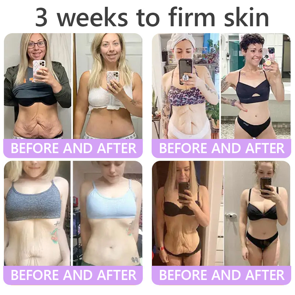 𝐇𝐈𝐒𝐊𝐈𝐍® 𝐏𝐃𝐑𝐍 𝐌𝐮𝐥𝐭𝐢-𝐏𝐞𝐩𝐭𝐢𝐝𝐞 𝐌𝐚𝐬𝐬𝐚𝐠𝐢𝐧𝐠 𝐁𝐨𝐝𝐲 𝐑𝐨𝐥𝐥𝐞𝐫 𝐂𝐫𝐞𝐚𝐦- Anti-aging, Hydrating, Skin Firming & Lifting, Skin Repair, Even Tone, Acne and Dark Spot Treatment, Wart and Mole Removal, and Psoriasis Relief.